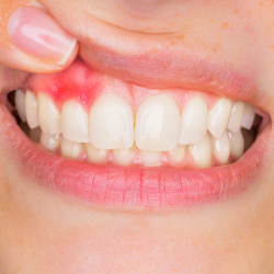 Gingivitis Nedir?