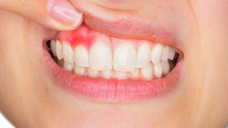 Gingivitis Nedir?